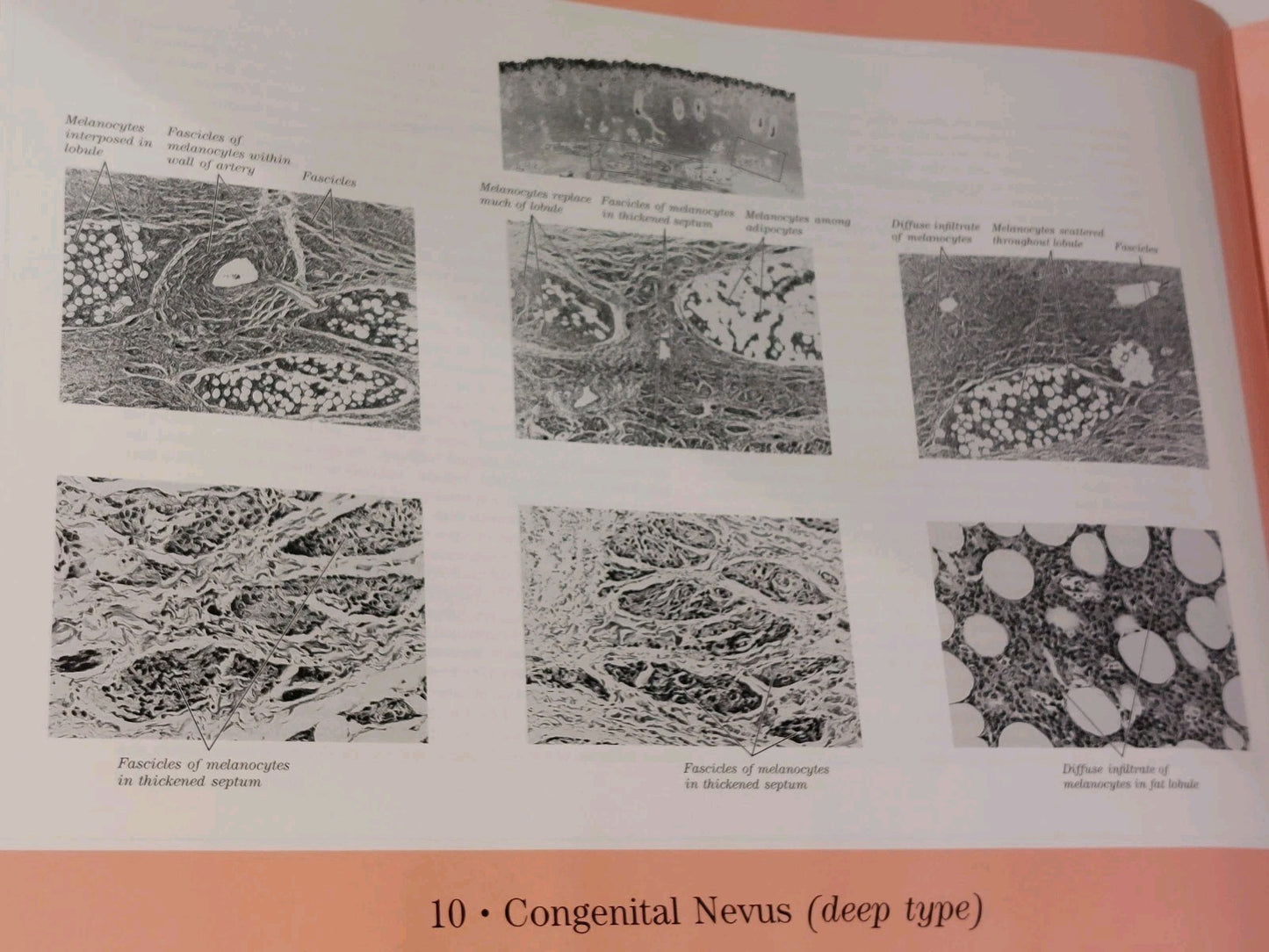 Pitfalls in Histopathologic Diagnosis of Malignant Melanoma by Bernard (1994)4