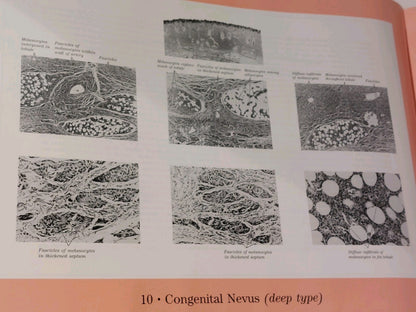 Pitfalls in Histopathologic Diagnosis of Malignant Melanoma by Bernard (1994)4