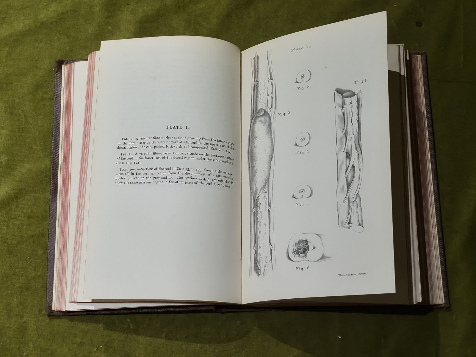 A Collection Of The Published Writings Of William Withey Gull M.D. 1894 HB 1st5