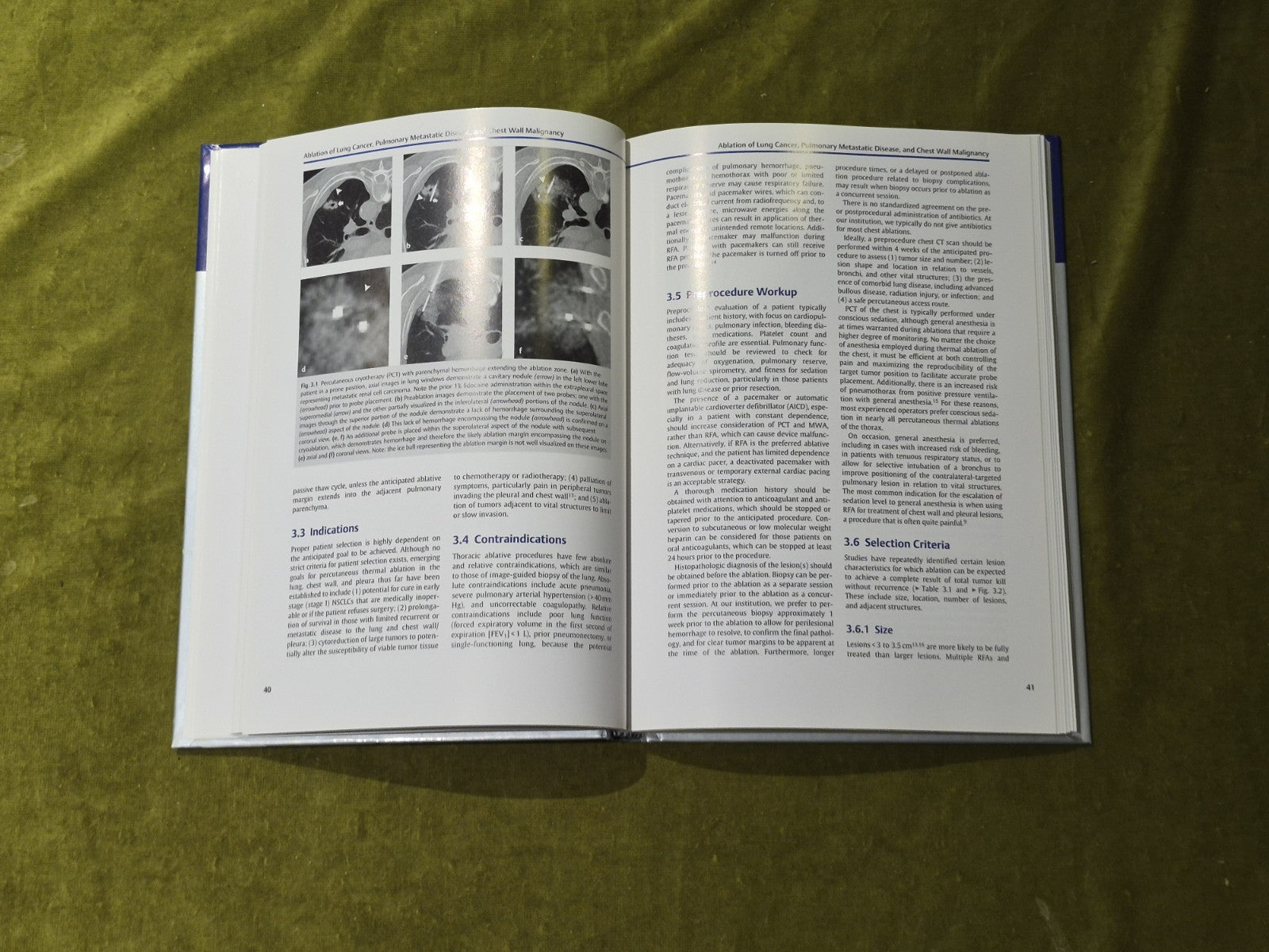 Interventional Oncology (Practical Guides in Interventional Radiology) - Thieme6